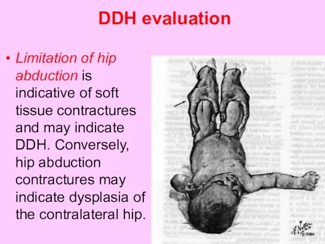 DDH evaluation Limitation of hip abduction is indicative of soft tissue