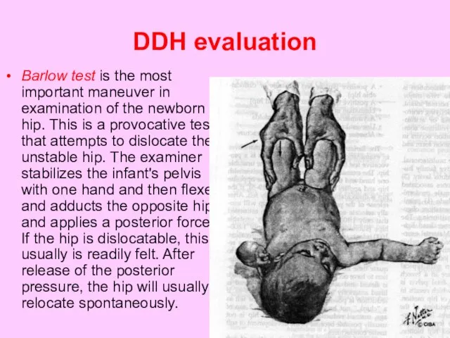 DDH evaluation Barlow test is the most important maneuver in examination