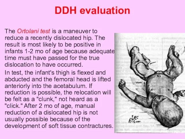 DDH evaluation The Ortolani test is a maneuver to reduce a