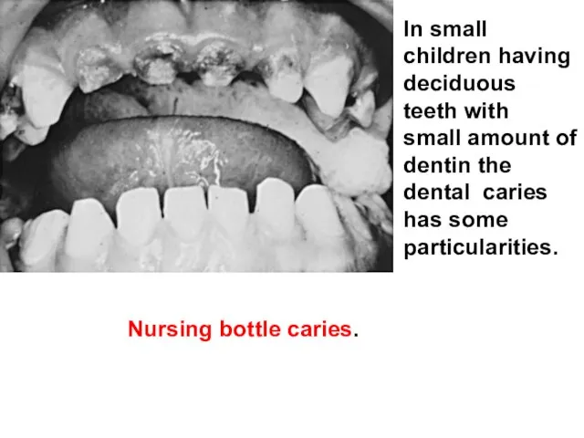 In small children having deciduous teeth with small amount of dentin