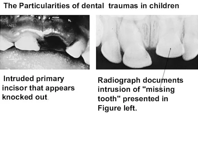 The Particularities of dental traumas in children Intruded primary incisor that