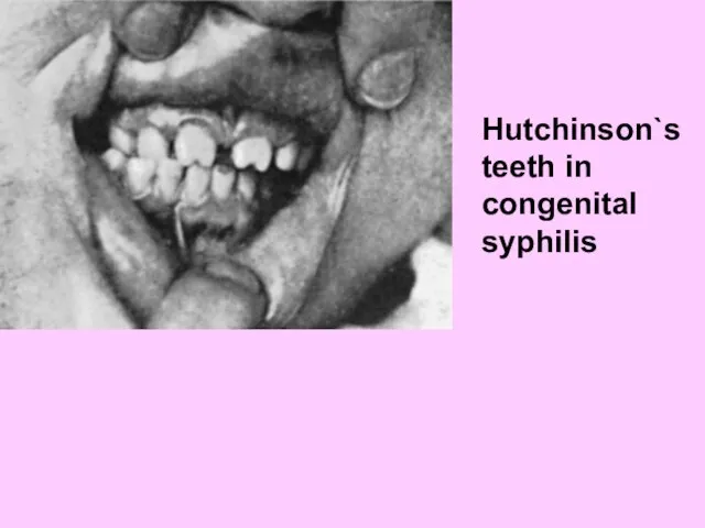 Hutchinson`s teeth in congenital syphilis