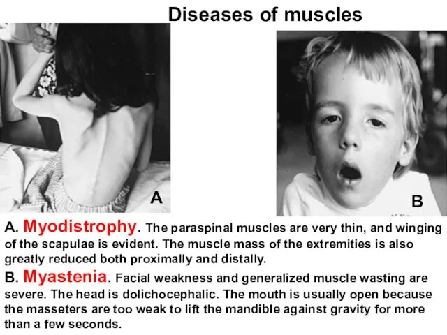 А. Myodistrophy. The paraspinal muscles are very thin, and winging of