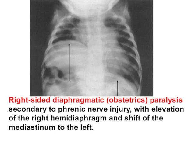 Right-sided diaphragmatic (obstetrics) paralysis secondary to phrenic nerve injury, with elevation