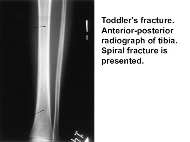 Toddler's fracture. Anterior-posterior radiograph of tibia. Spiral fracture is presented.