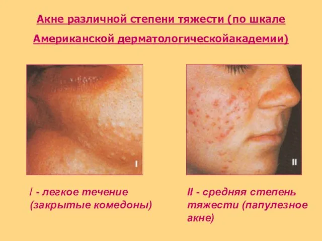 Акне различной степени тяжести (по шкале Американской дерматологическойакадемии) / - легкое