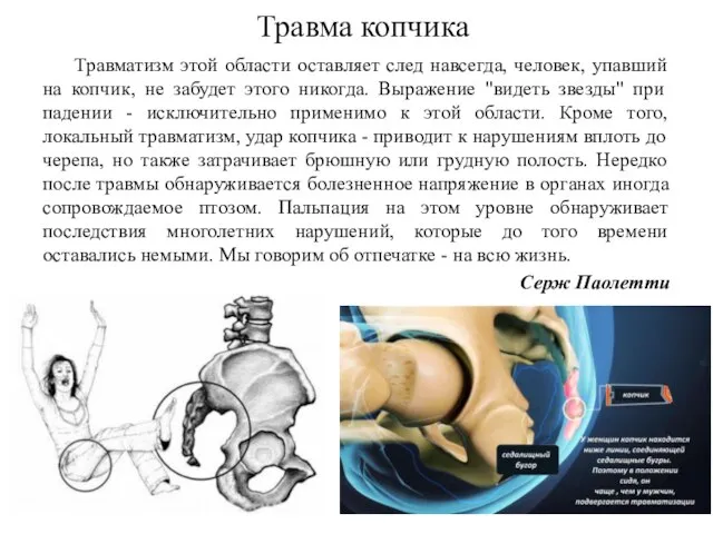 Травматизм этой области оставляет след навсегда, человек, упавший на копчик, не