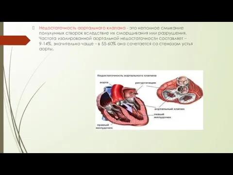 Недостаточность аортального клапана - это неполное смыкание полулунных створок вследствие их