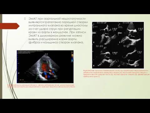 ЭхоКГ при аортальной недостаточности выявляются трепетание передней створки митрального клапана во