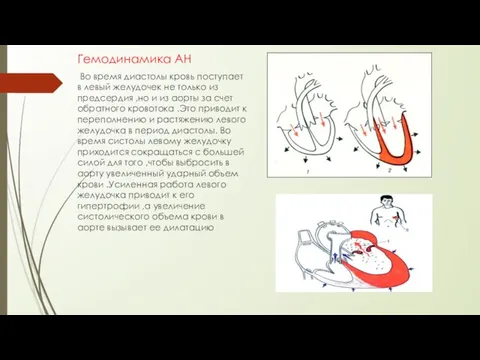 Гемодинамика АН Во время диастолы кровь поступает в левый желудочек не