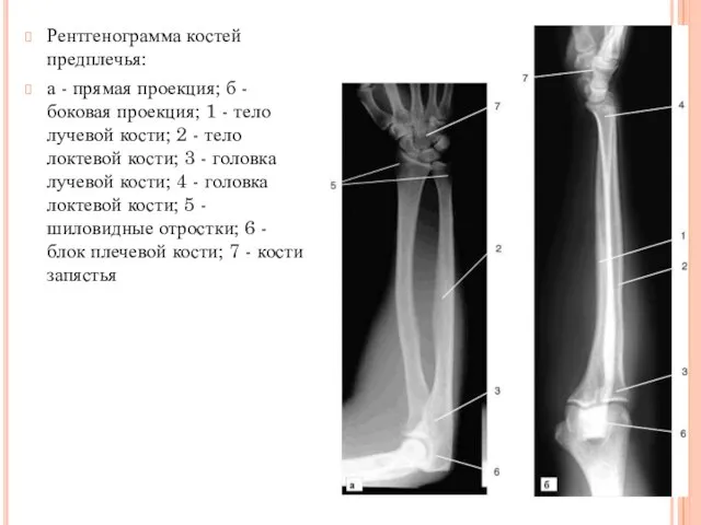 Рентгенограмма костей предплечья: а - прямая проекция; б - боковая проекция;