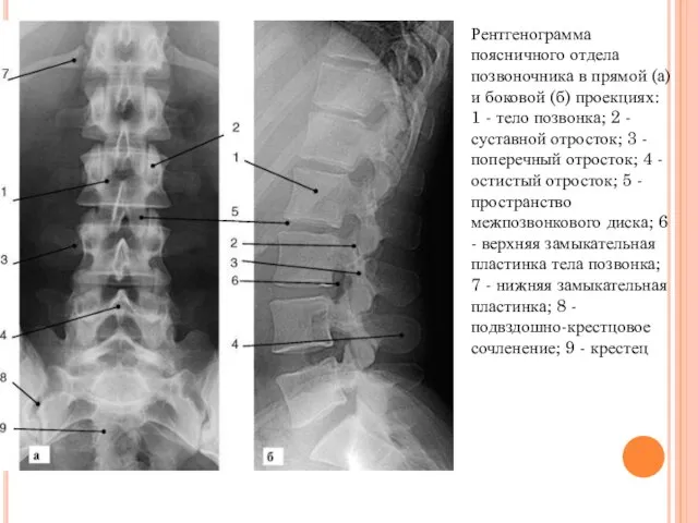 Рентгенограмма поясничного отдела позвоночника в прямой (а) и боковой (б) проекциях: