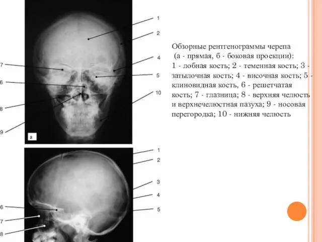 Обзорные рентгенограммы черепа (а - прямая, б - боковая проекции): 1