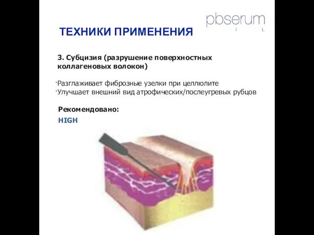 3. Субцизия (разрушение поверхностных коллагеновых волокон) Разглаживает фиброзные узелки при целлюлите