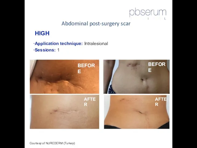 Abdominal post-surgery scar Courtesy of NUREDERM (Turkey) HIGH Application technique: Intralesional