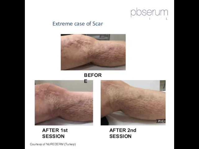 Extreme case of Scar Courtesy of NUREDERM (Turkey) BEFORE AFTER 2nd SESSION AFTER 1st SESSION