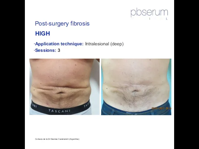 Cortesía de la Dr Desiree Castelanich (Argentina) Post-surgery fibrosis HIGH Application technique: Intralesional (deep) Sessions: 3