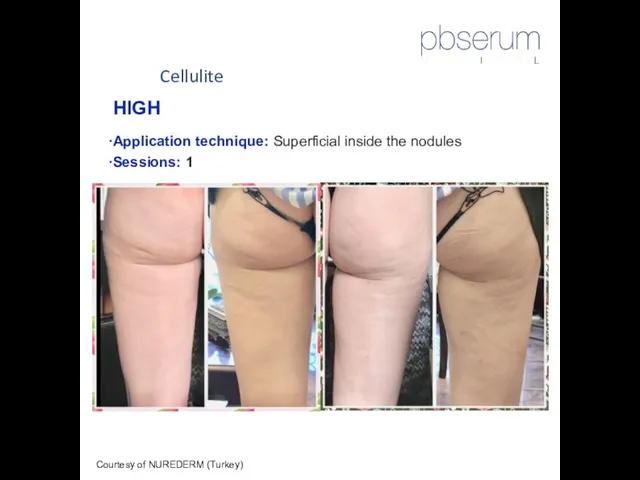 Cellulite Courtesy of NUREDERM (Turkey) HIGH Application technique: Superficial inside the nodules Sessions: 1