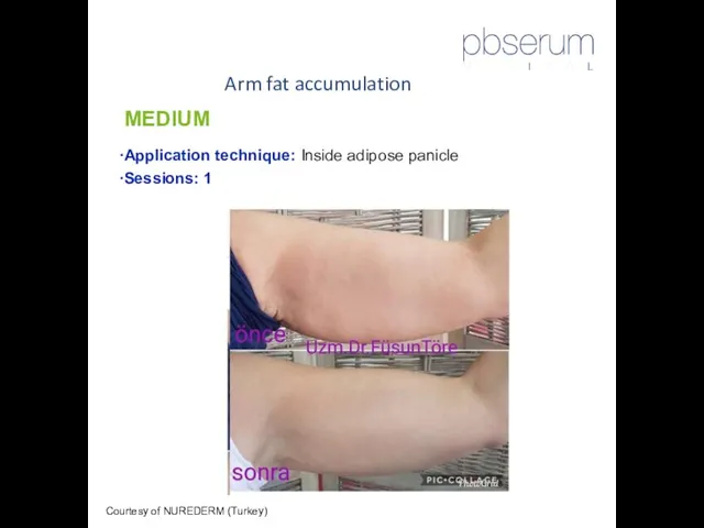 Arm fat accumulation Courtesy of NUREDERM (Turkey) MEDIUM Application technique: Inside adipose panicle Sessions: 1