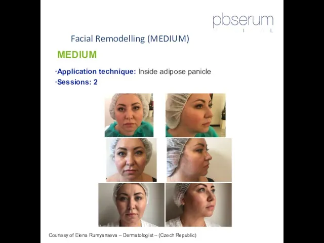 Facial Remodelling (MEDIUM) Courtesy of Elena Rumyanseva – Dermatologist – (Czech