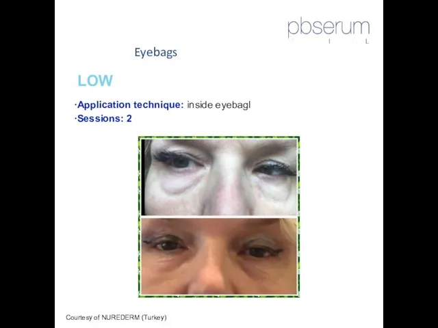 Eyebags Courtesy of NUREDERM (Turkey) LOW Application technique: inside eyebagl Sessions: 2