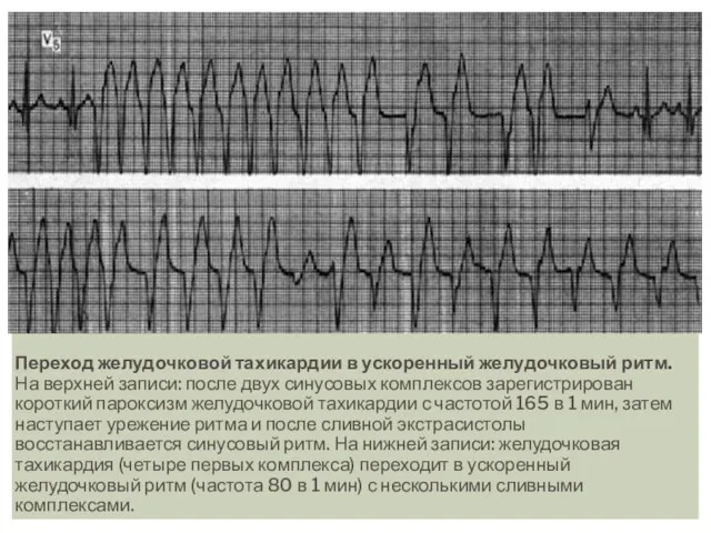 Переход желудочковой тахикардии в ускоренный желудочковый ритм. На верхней записи: после