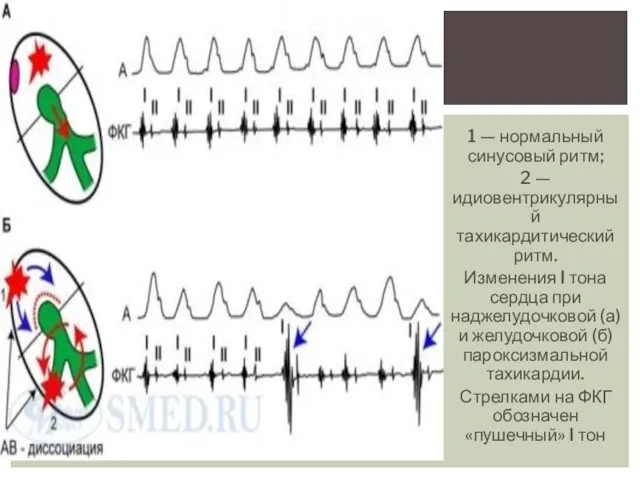 1 — нормальный синусовый ритм; 2 — идиовентрикулярный тахикардитический ритм. Изменения