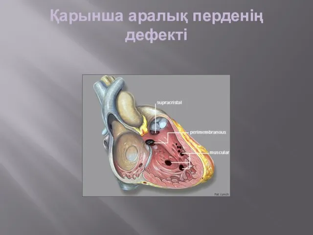 Қарынша аралық перденің дефекті