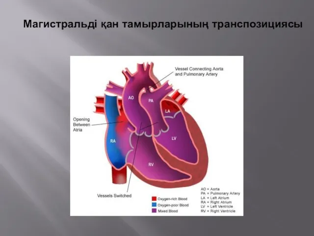 Магистральді қан тамырларының транспозициясы