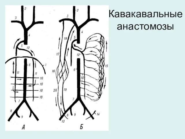 Кавакавальные анастомозы