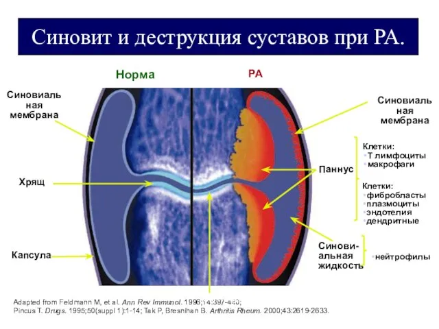 Синовит и деструкция суставов при РА. Норма РА Синовиальная мембрана Хрящ