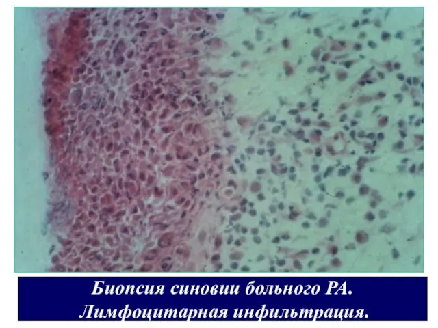 Биопсия синовии больного РА. Лимфоцитарная инфильтрация.