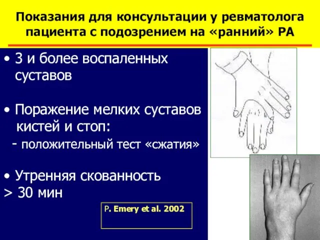 Показания для консультации у ревматолога пациента с подозрением на «ранний» РА