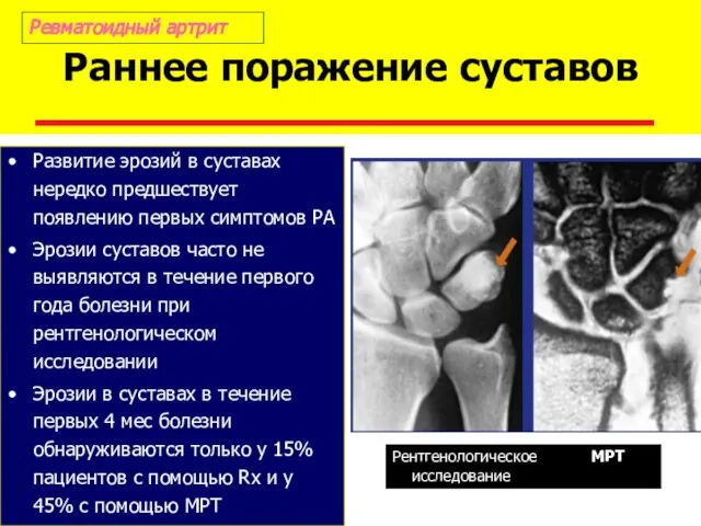 Раннее поражение суставов Развитие эрозий в суставах нередко предшествует появлению первых