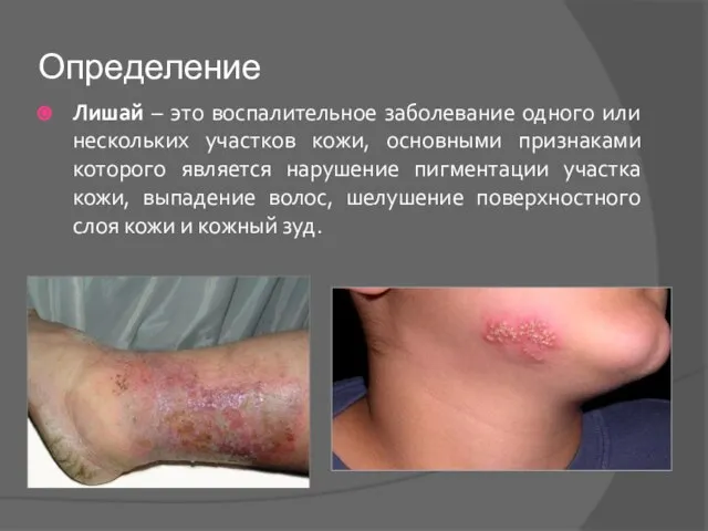 Определение Лишай – это воспалительное заболевание одного или нескольких участков кожи,