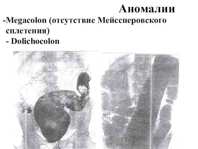 Аномалии Megacolon (отсутствие Мейсснеровского сплетения) - Dolichocolon