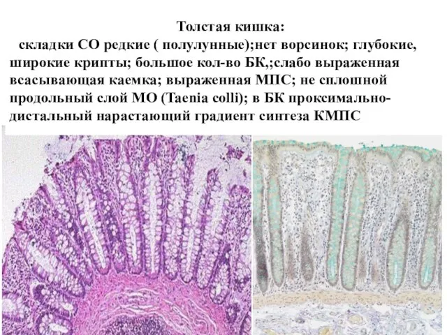 Толстая кишка: складки СО редкие ( полулунные);нет ворсинок; глубокие, широкие крипты;