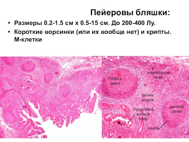 Пейеровы бляшки: Размеры 0.2-1.5 см х 0.5-15 см. До 200-400 Лу.