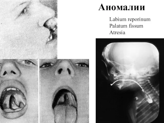 Аномалии Labium reporinum Palatum fissum Atresia