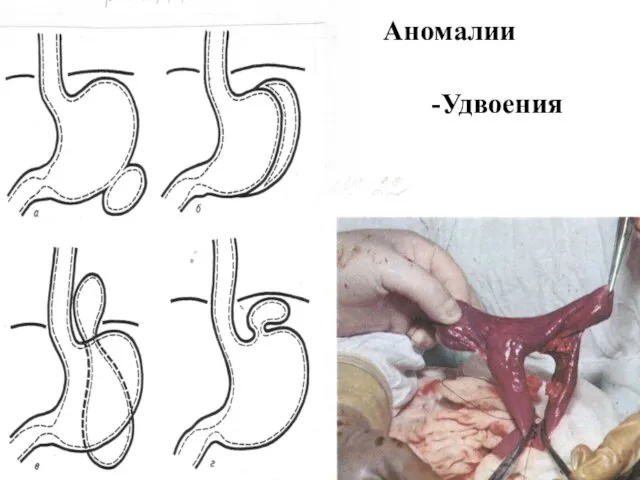 Аномалии Удвоения