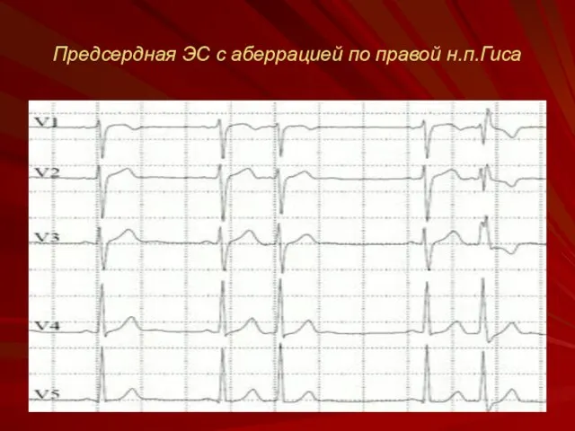 Предсердная ЭС с аберрацией по правой н.п.Гиса