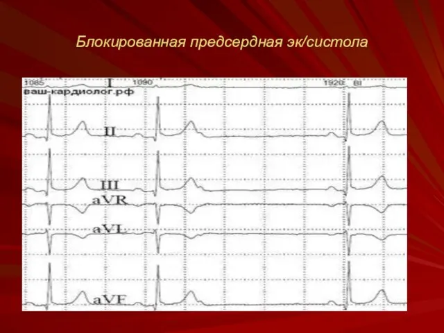 Блокированная предсердная эк/систола