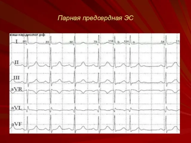 Парная предсердная ЭС