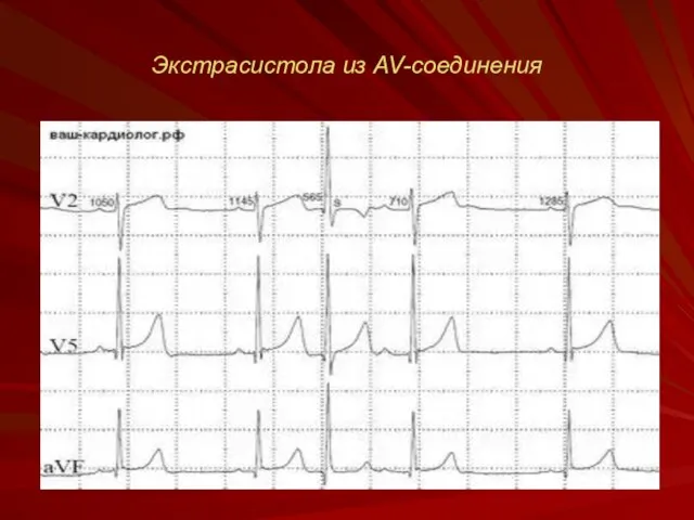 Экстрасистола из AV-соединения