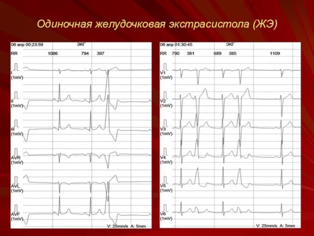 Одиночная желудочковая экстрасистола (ЖЭ)