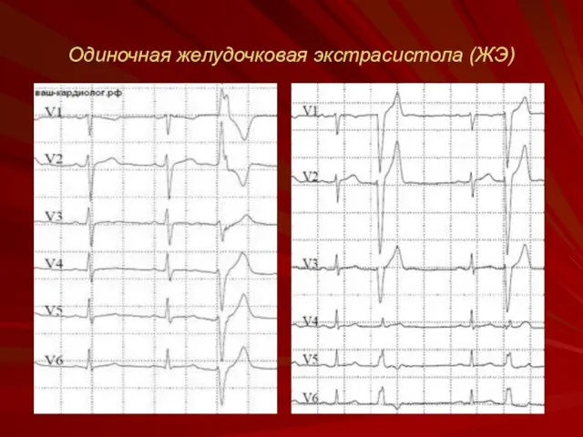 Одиночная желудочковая экстрасистола (ЖЭ)