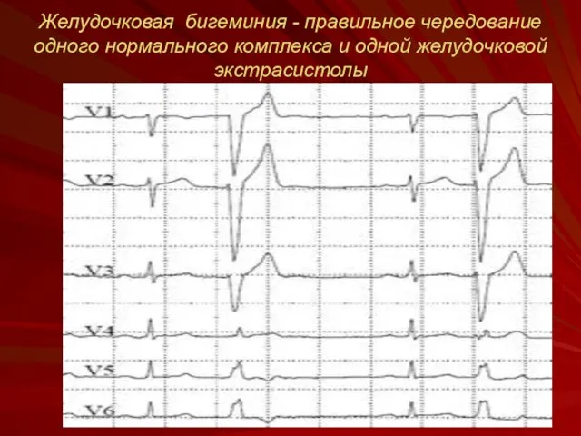 Желудочковая бигеминия - правильное чередование одного нормального комплекса и одной желудочковой экстрасистолы