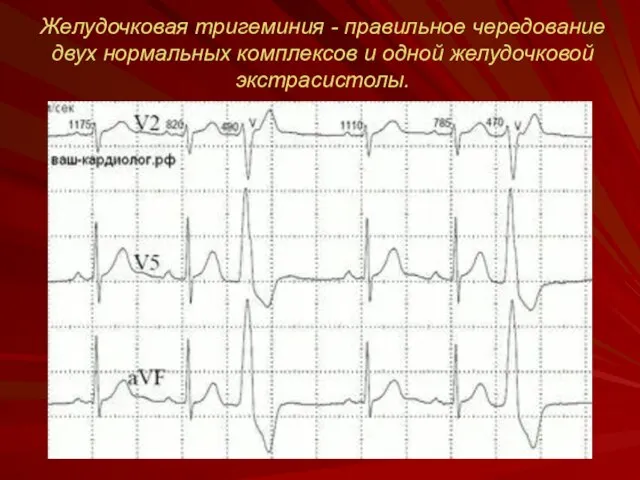 Желудочковая тригеминия - правильное чередование двух нормальных комплексов и одной желудочковой экстрасистолы.