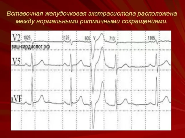 Вставочная желудочковая экстрасистола расположена между нормальными ритмичными сокращениями.