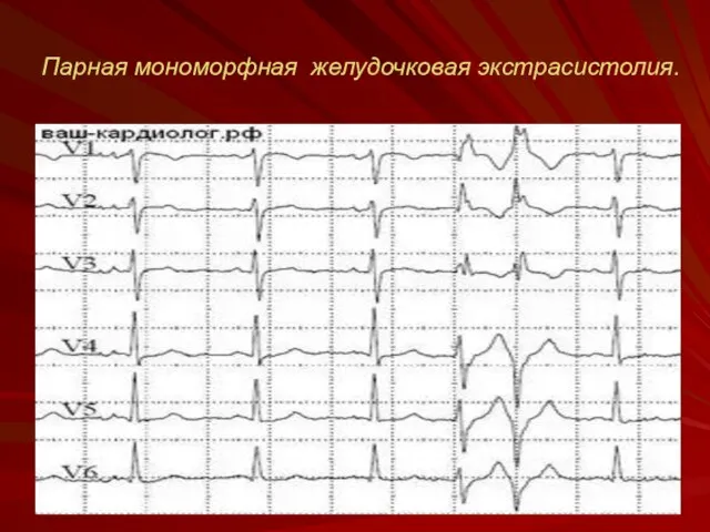 Парная мономорфная желудочковая экстрасистолия.